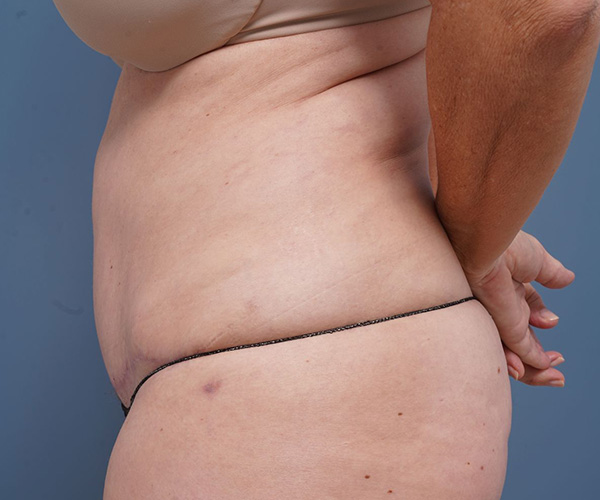after tummy tuck left side view female patient case 2351