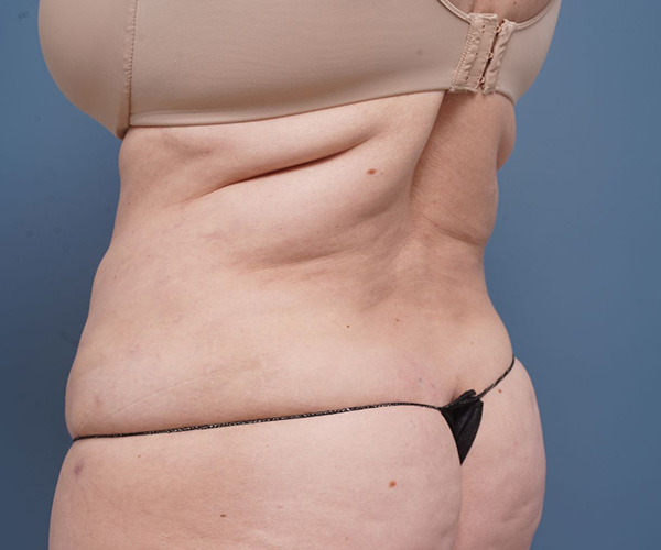 after tummy tuck left angle view female patient case 2351