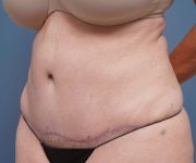 after tummy tuck left angle view female patient case 2351