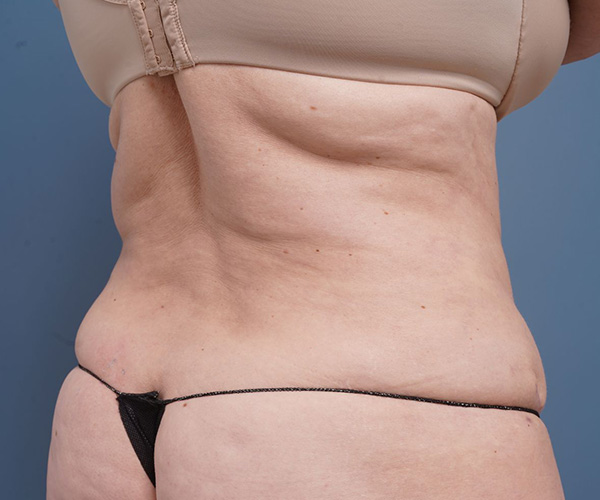 after tummy tuck right angle view female patient case 2351
