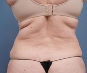 after tummy tuck back view female patient case 2351